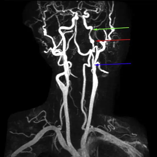 carotid mr angiography with contrast